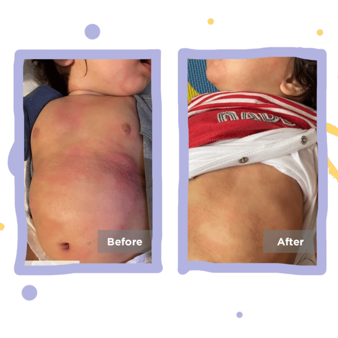 eczema sleepsuit before & after
