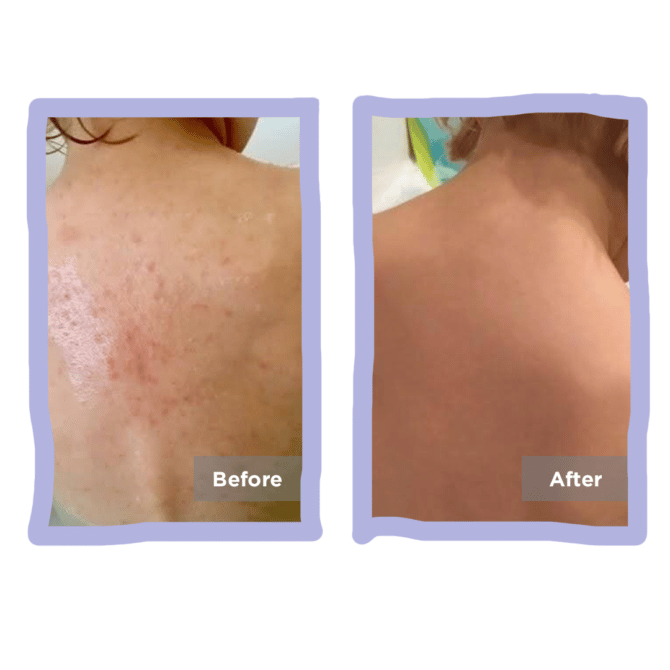 before and after back