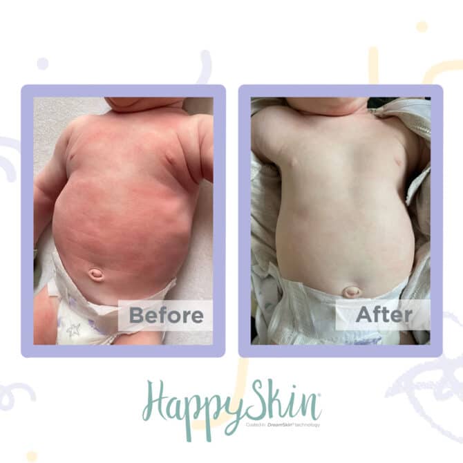baby eczema treatment before and after