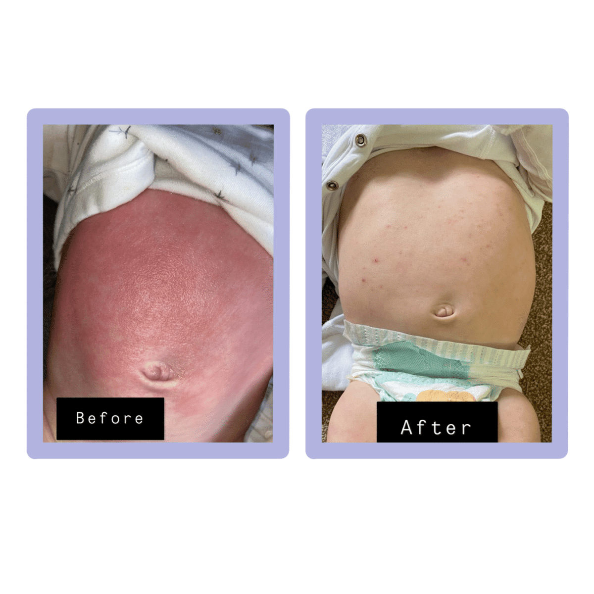 Severe Eczema Baby Pack for Treatment of the Skin | HappySkin