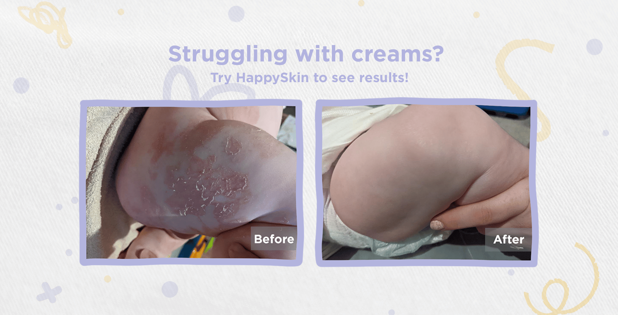 eczema cream alternative