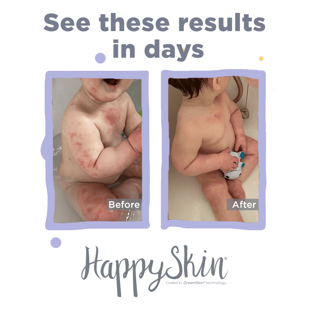 April Before and After, severe baby eczema