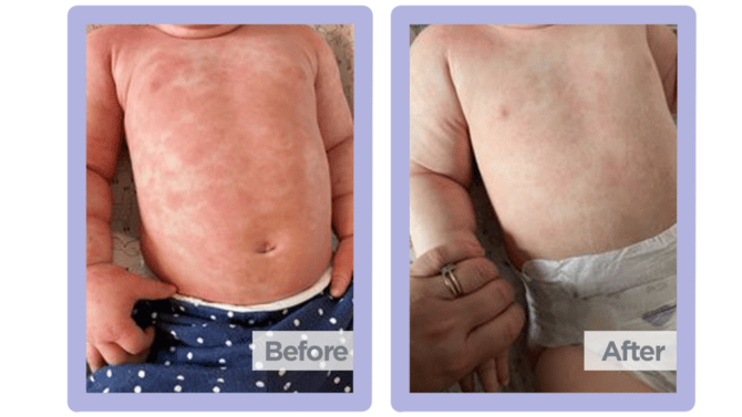 how to treat eczema on babies chest and belly