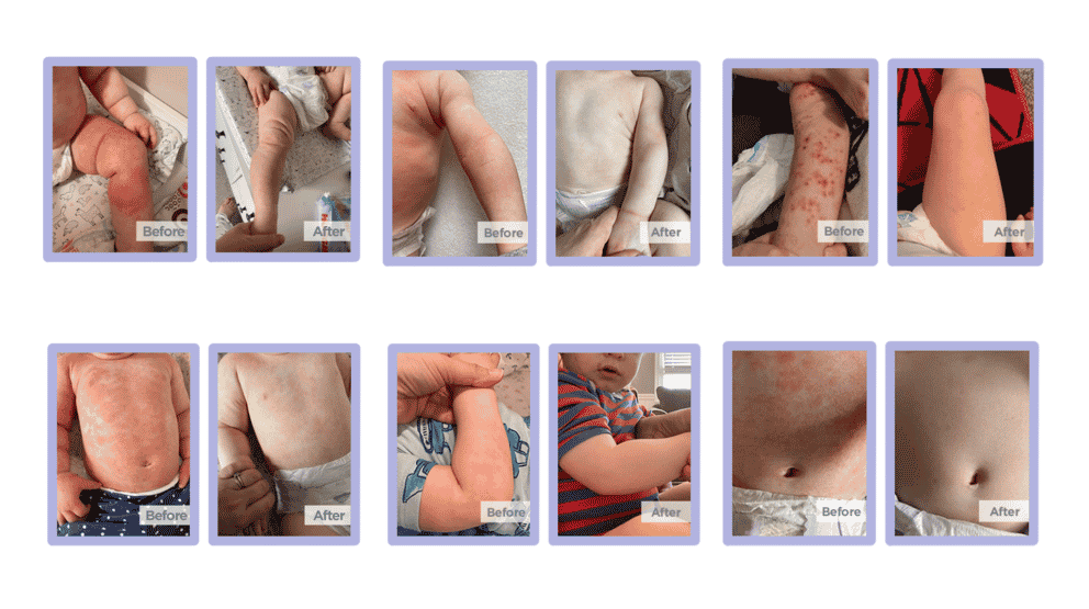 atopic eczema baby before and after photos