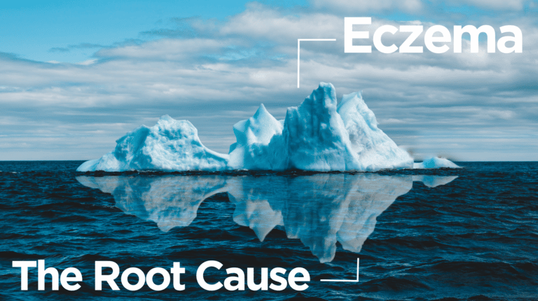 What is the root cause of eczema