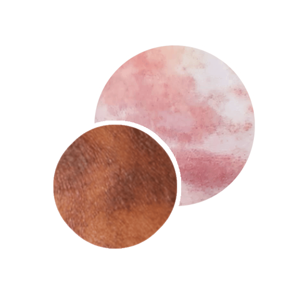 eczema on baby skin type