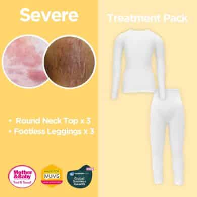 child severe eczema treatment pack