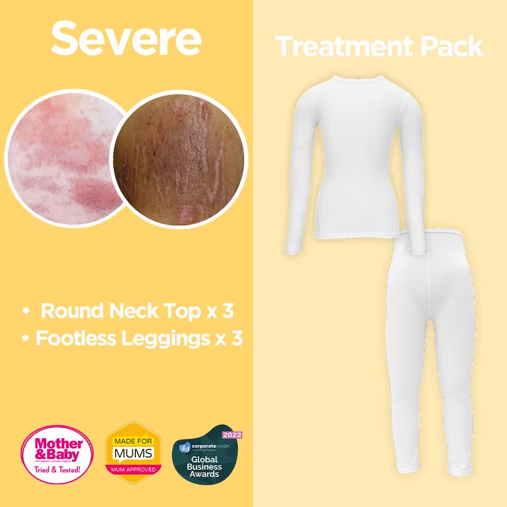 Severe Eczema Child Treatment Pack HappySkin