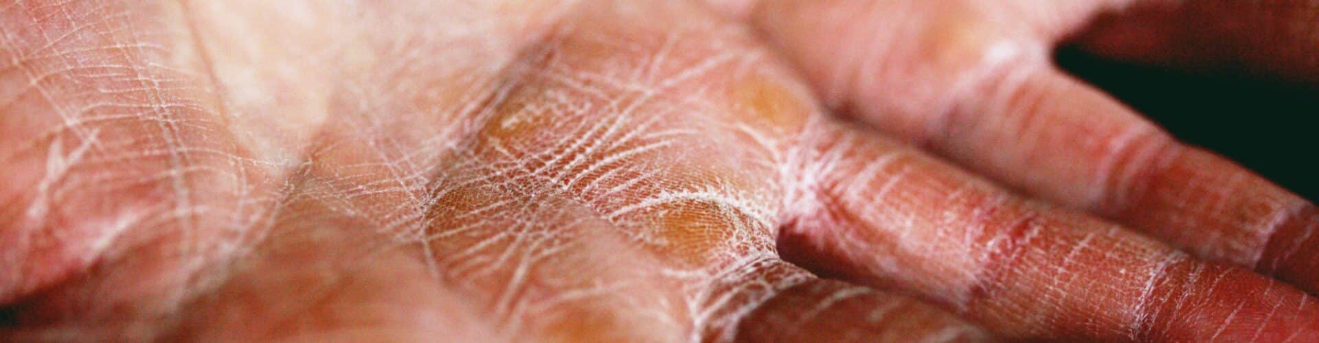 Eczema on Hands
