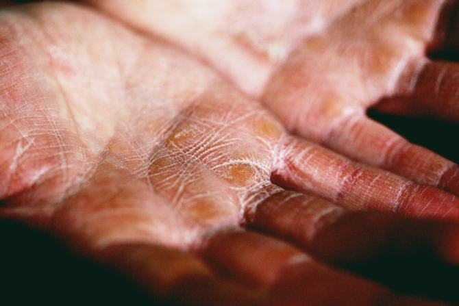 Eczema on Hands
