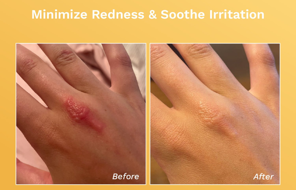Before and after using rejuvaskin baby eczema ream
