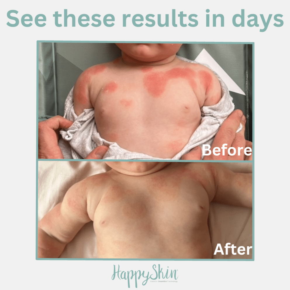 before & after of wearing HappySkin eczema clothing