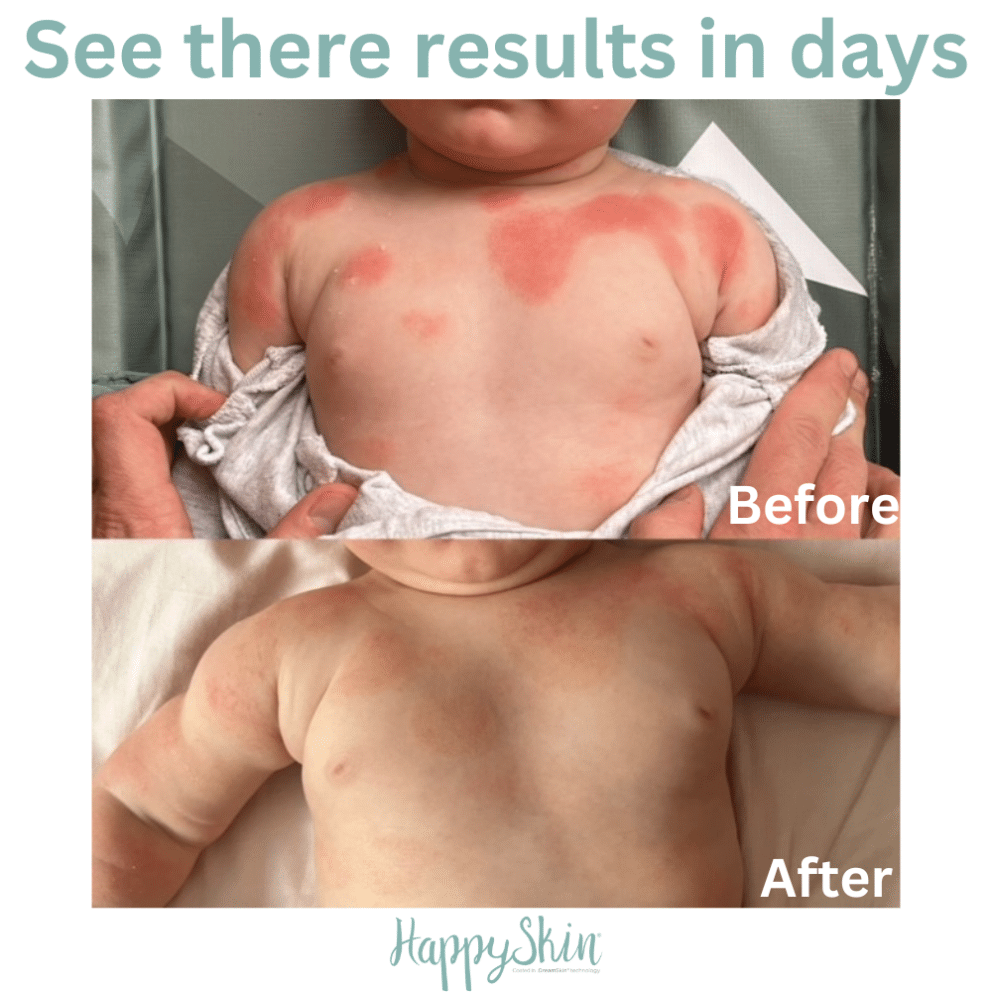 happyskin before & after