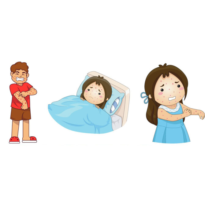 how to treat chicken pox