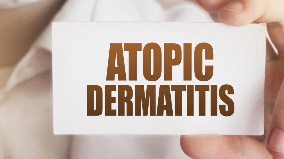 Relief from Atopic Dermatitis