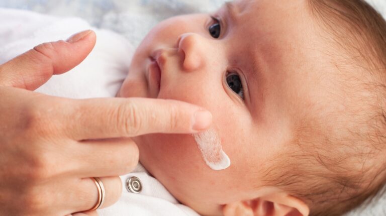 Does Tmilk Help Baby Eczema
