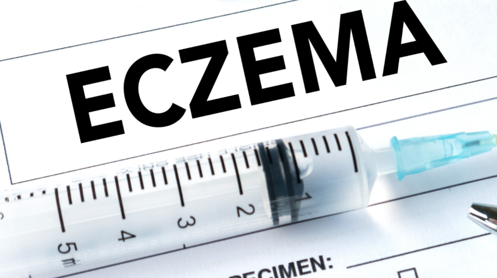 what is eczema?