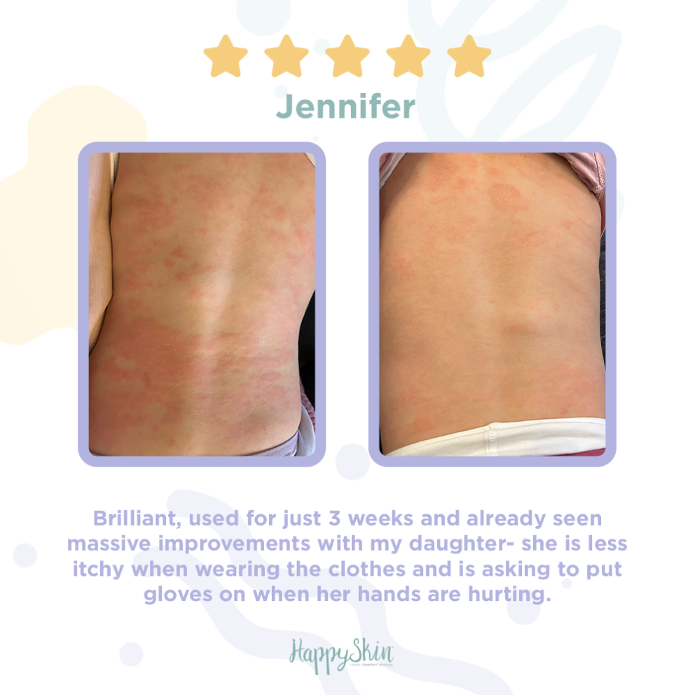 Eczema looks like Picture Before and After