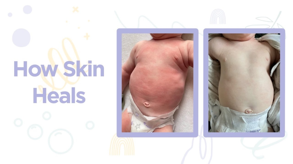 HappySkin Healing Process