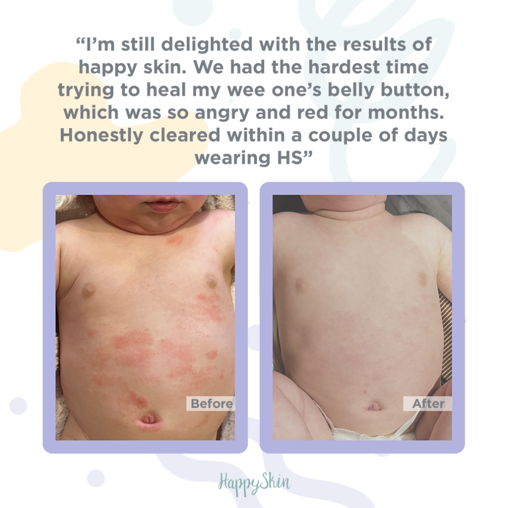 Eczema Before and After