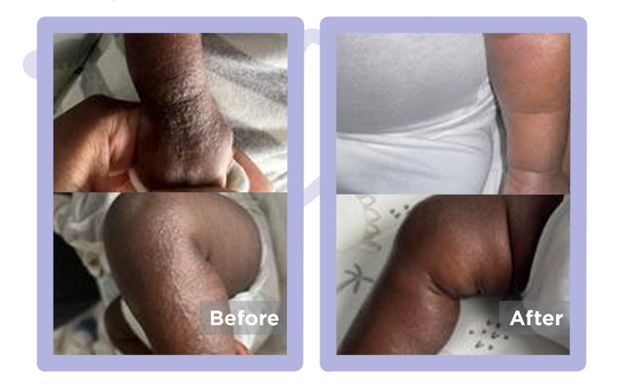 eczema on dark baby skin pictures under the knees