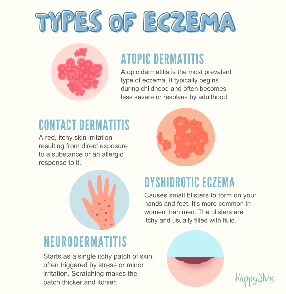 different types of eczema illustration with text