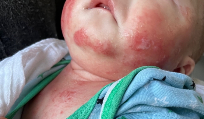Baby drooling causing irritation around the neck area before using HappySkin