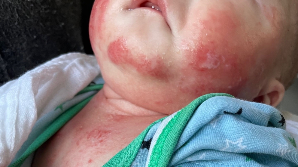 Baby drooling causing irritation around the neck area before using HappySkin
