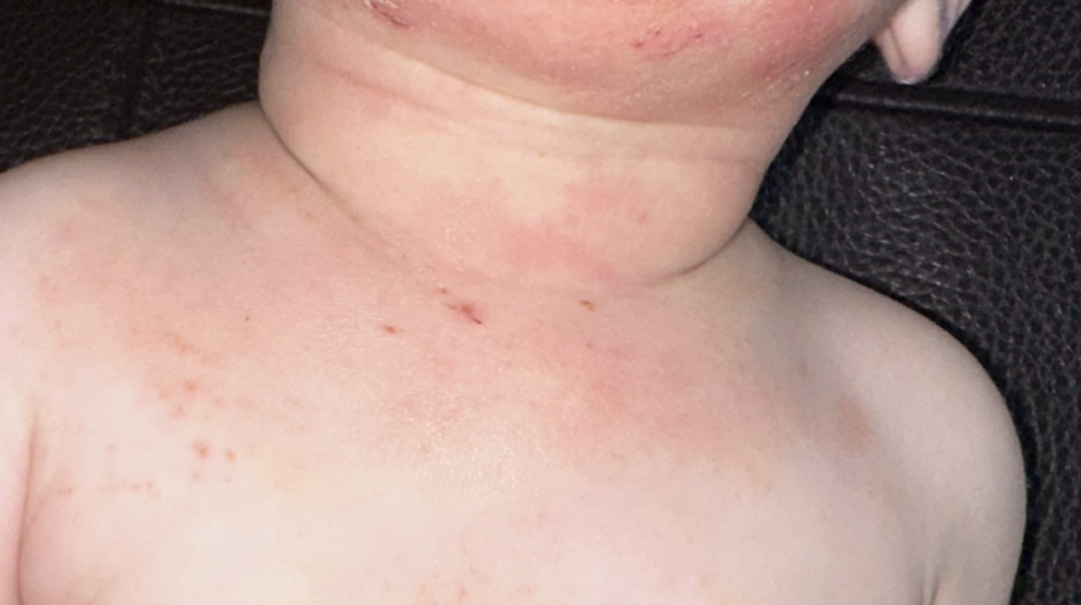 Mild neck irritation in a toddler caused by friction from clothing